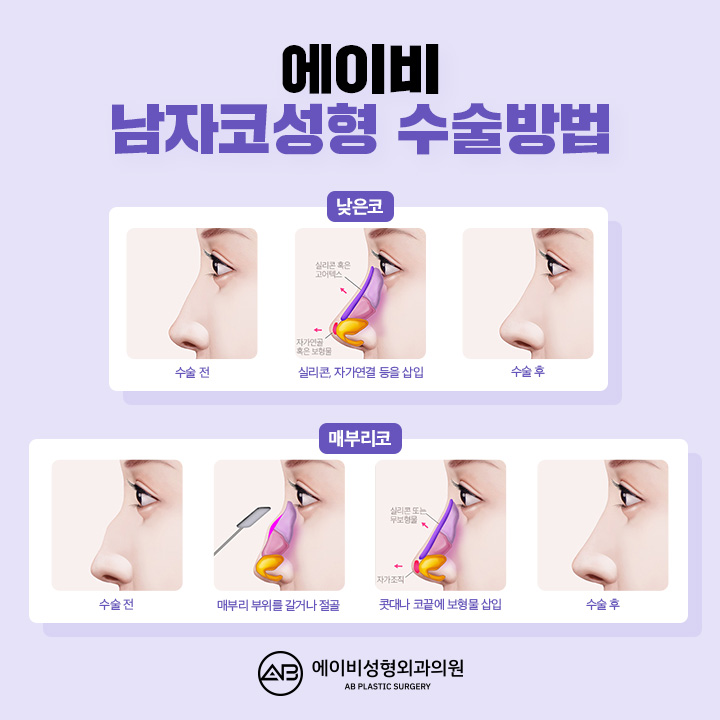 남자기능코수술 이렇게만 하면 돼 관련 이미지 4