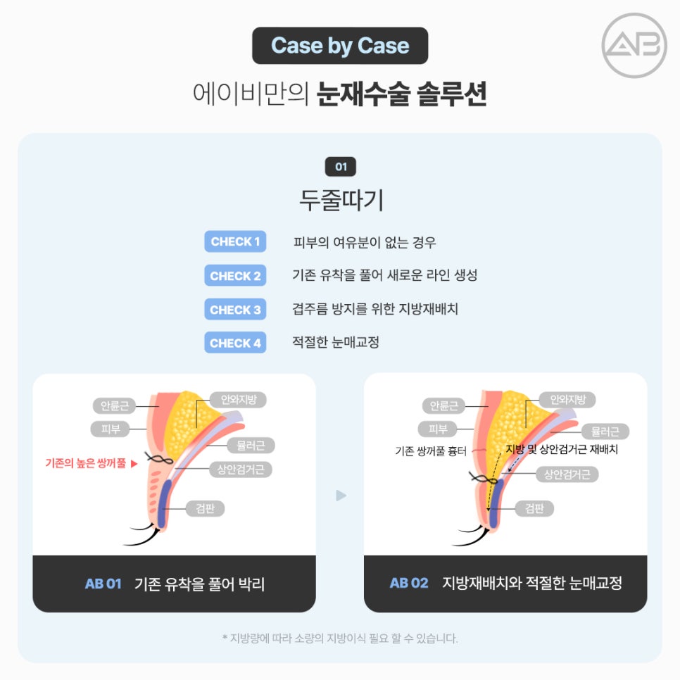 에이비성형외과 쌍꺼풀 짝눈 눈재수술종류 전후 관련 이미지 5