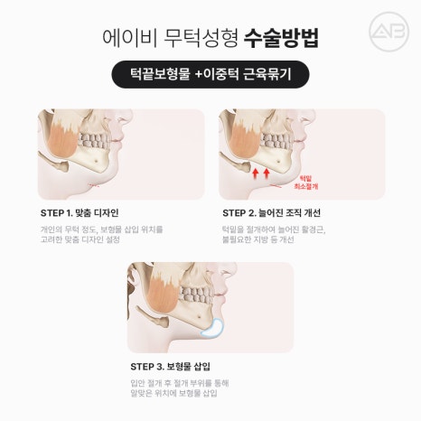 무턱성형 고려하고 있다면 AB성형외과 관련 이미지 7