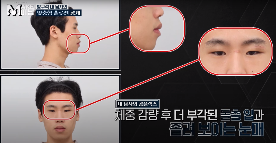 [AB Plastic Surgery Featured on Broadcast] LG HelloVision & KBSjoy image 13