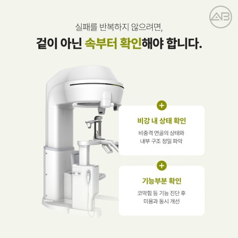 에이비성형외과 자가늑연골 비주라인 코재수술 시기와 교정 체크포인트 관련 이미지 4