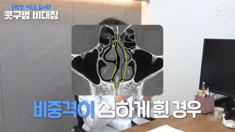 #에이비성형외과#에이비tv#코성형#콧구멍비대칭 관련 이미지 7