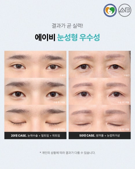 에이비성형외과 눈성형연구회에서 관련 이미지 6