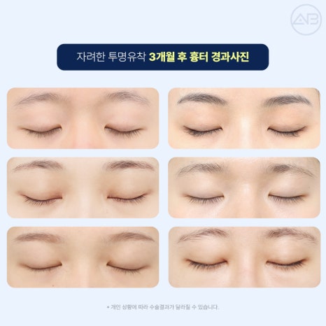 Transparent Adhesion for a Refined Look: AB Plastic Surgery for Attractive Eyes image 7
