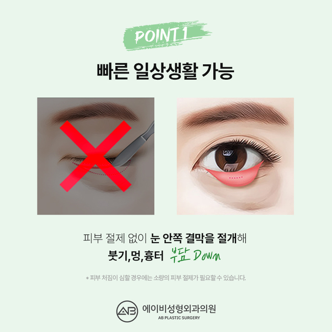 Differences in AB Plastic Surgery’s Mini Lower Blepharoplasty image 3