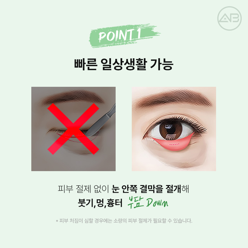 에이비성형외과 눈밑지방재배치 하안검 수술 전후 다크서클 개선과 에이빛주사 이벤트 관련 이미지 4