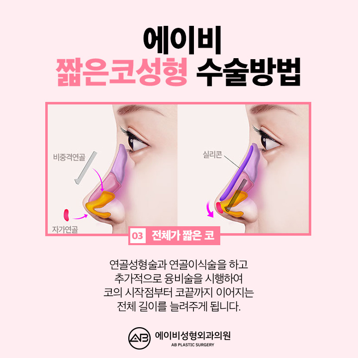 If You’re Looking Into Short Nose Surgery, Pay Attention to This Place image 5