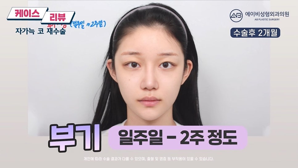 #에이비성형외과#에이비tv#케이스리뷰#코성형#코재수술 관련 이미지 6