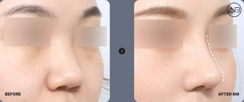 에이비성형외과 자려한 비주라인 코성형수술 관련 이미지 3