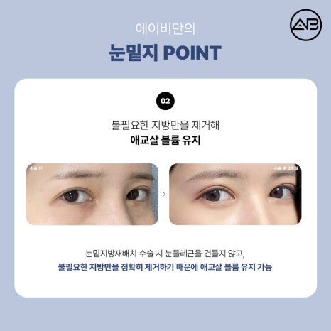 에이비성형외과의원 눈밑지방재배치 눈밑지 수술 방법 후기 관련 이미지 6