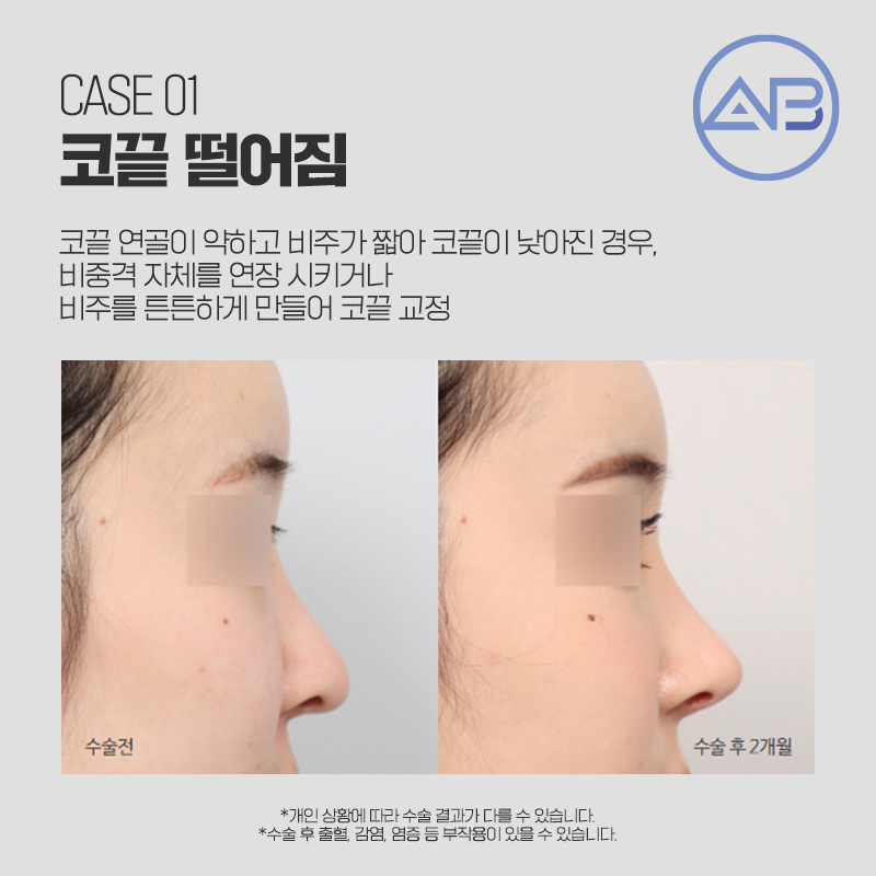 코재수술성형외과 에이비만 믿어! 관련 이미지 1