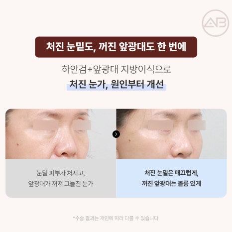 에이비성형외과 10월 자려한 가을이벤트 관련 이미지 3