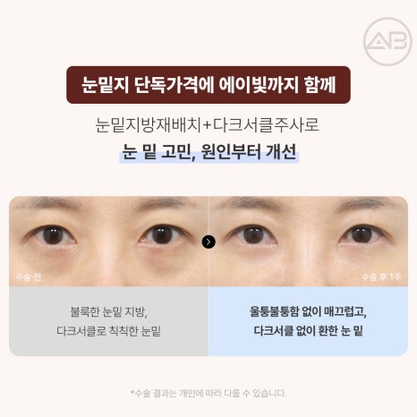 에이비성형외과 10월 자려한 가을이벤트 관련 이미지 2