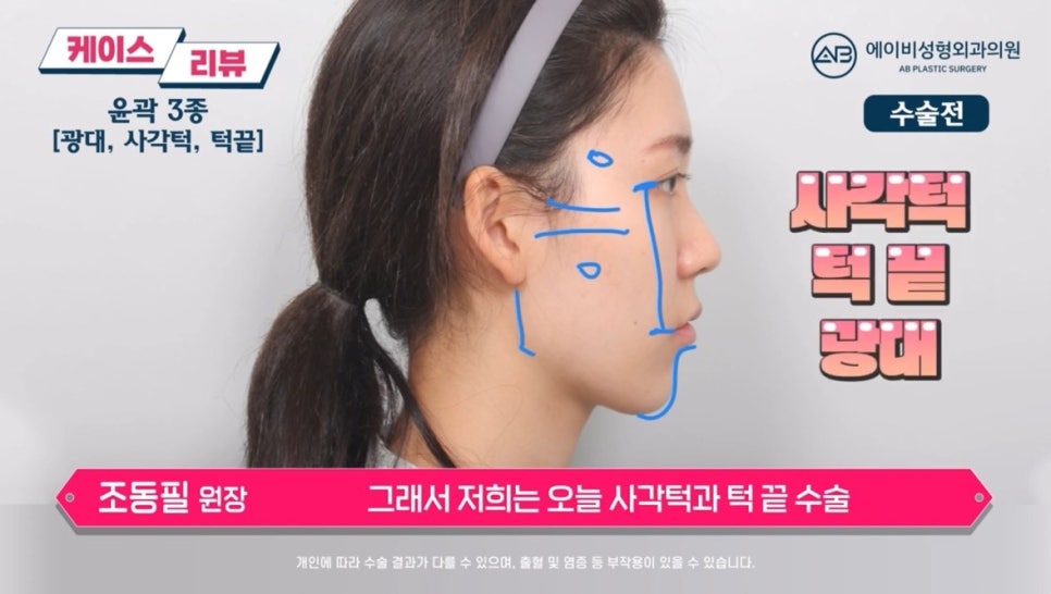 #에이비성형외과#에이비tv#케이스리뷰#안면윤곽성형 관련 이미지 4