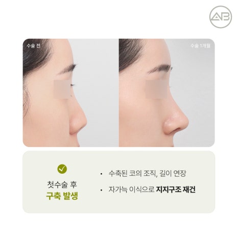 에이비성형외과 자가늑연골 비주라인 코재수술 시기와 교정 체크포인트 관련 이미지 7