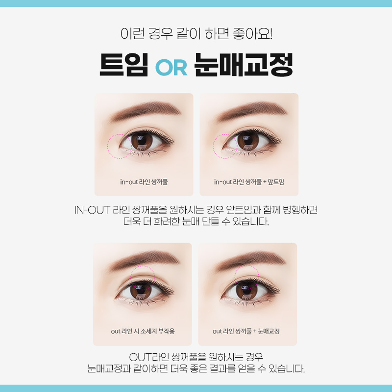 쌍꺼풀수술 자연유착 매몰법 VS 절개법 차이 관련 이미지 5