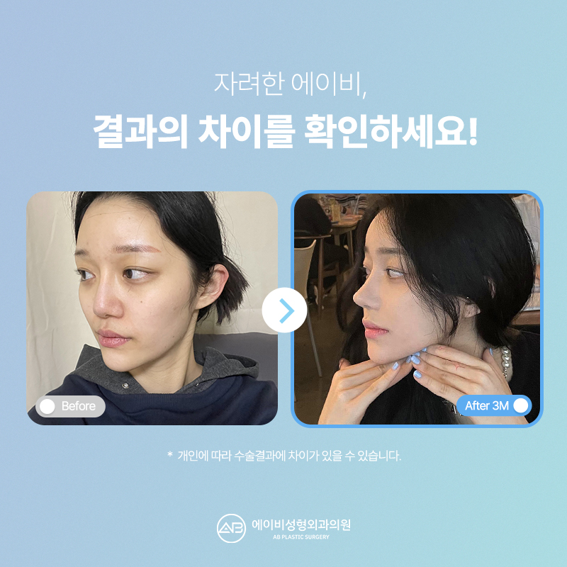 Key Points of AB Plastic Surgery’s Refined Nose Surgery image 6
