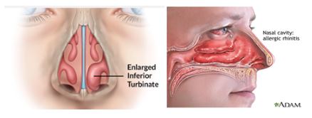 [Column] Is it possible to perform rhinoplasty for a male hump nose together with rhinitis surgery? image 4