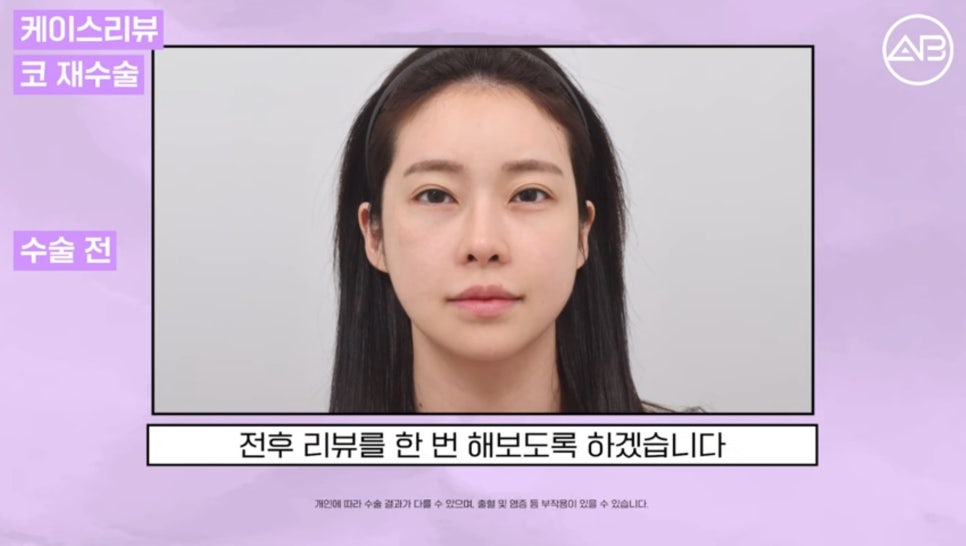 #AB Plastic Surgery #AB TV #Case Review #Nose Surgery #Revision Rhinoplasty image 1