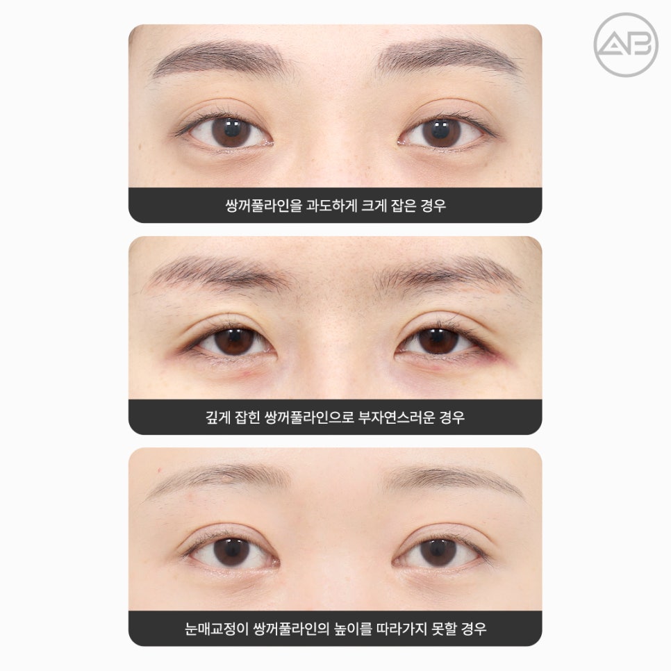 에이비성형외과 쌍꺼풀 짝눈 눈재수술종류 전후 관련 이미지 2