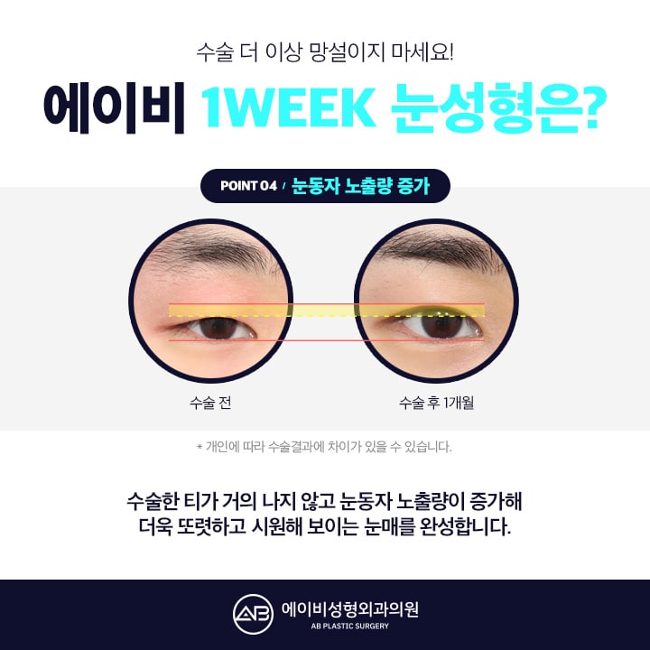 남자눈성형후기 AB성형외과는 남달라 관련 이미지 4