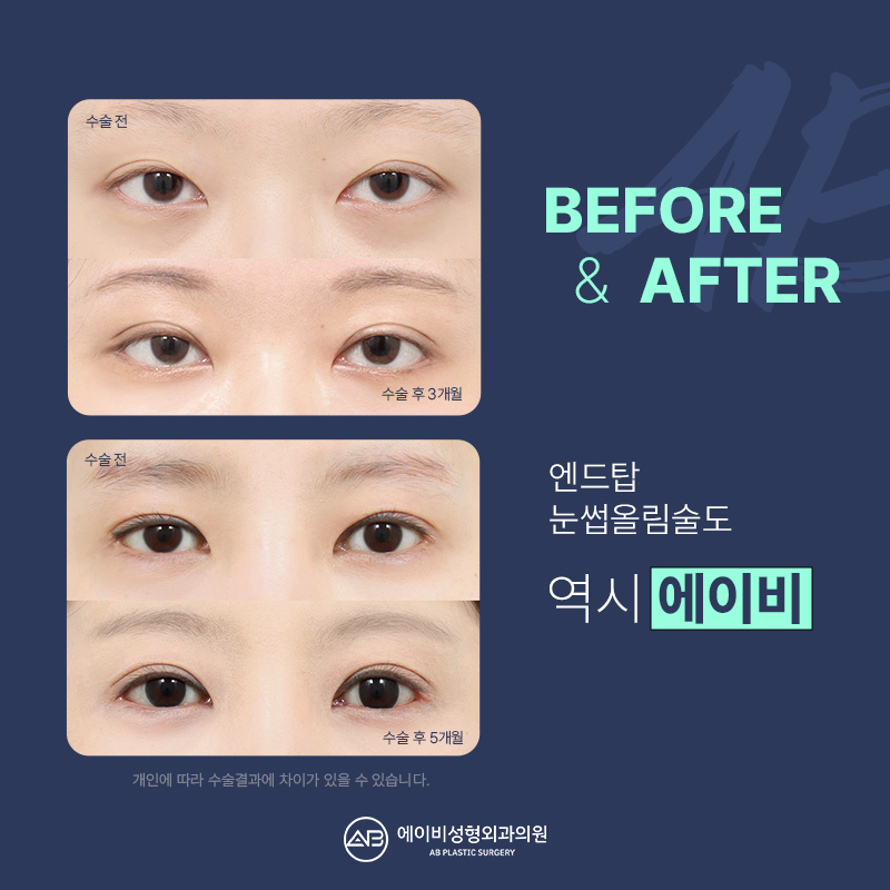 What Is the Endtop Eyebrow Lift That So Many People in Their 20s and 30s Are Getting? image 9