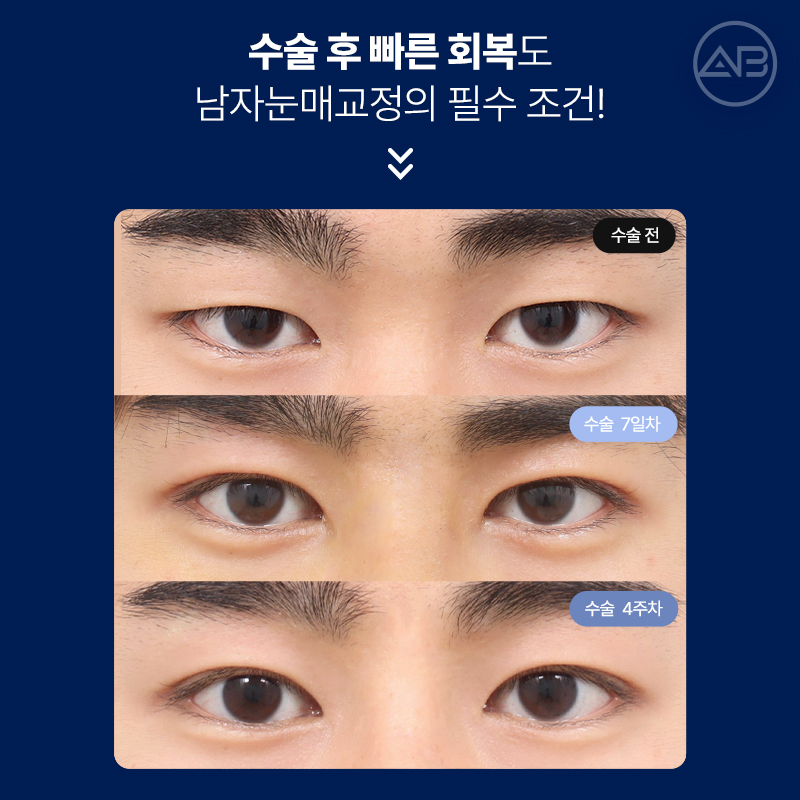 인상을 바꾸는 첫 시작, 에이비성형외과 남자눈성형 관련 이미지 15