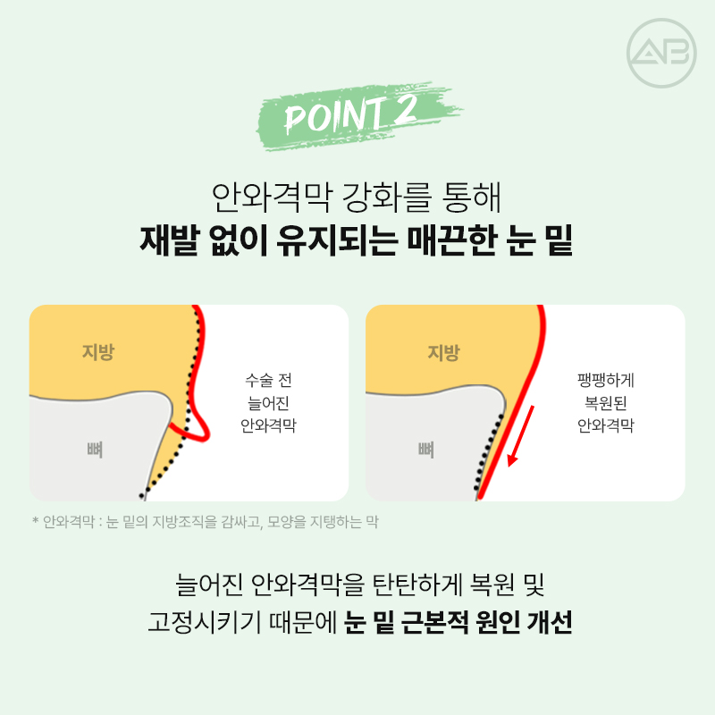 에이비성형외과 눈밑지방재배치 하안검 수술 전후 다크서클 개선과 에이빛주사 이벤트 관련 이미지 5