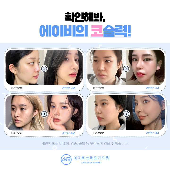 자려코성형 에이비만의 차별화 관련 이미지 4