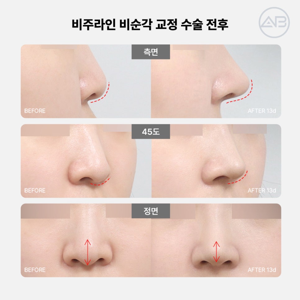 에이비성형외과 코끝수술전후 비주라인과 비순각교정수술이 중요한 이유 관련 이미지 3