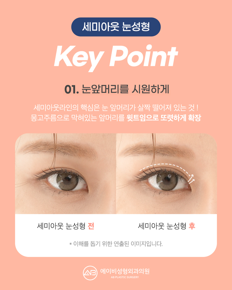 요즘 대세 세미아웃 눈성형 성공하려면? 관련 이미지 5
