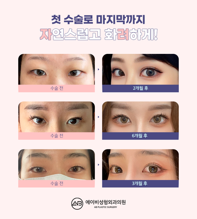 If You’re Looking for a Glamorous Double Eyelid Surgery, AB Plastic Surgery image 6
