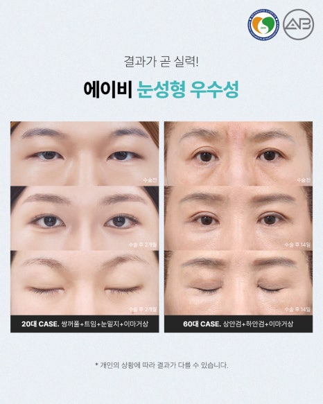 에이비성형외과 눈성형연구회에서 관련 이미지 7