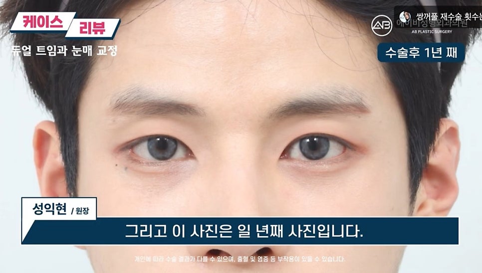 #에이비성형외과#에이비tv#눈성형#남자눈성형 관련 이미지 7
