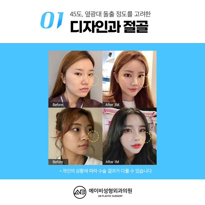 Can We Compare Before and After Cheekbone Surgery? image 3