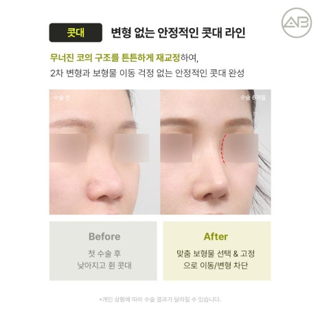 에이비성형외과 자가늑연골 비주라인 코재수술 시기와 교정 체크포인트 관련 이미지 10