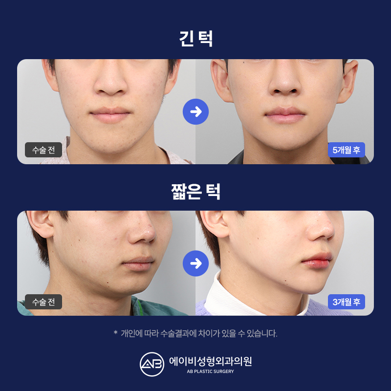 남자 윤곽수술잘하는곳 볼 때 고려해야 할 점 관련 이미지 11