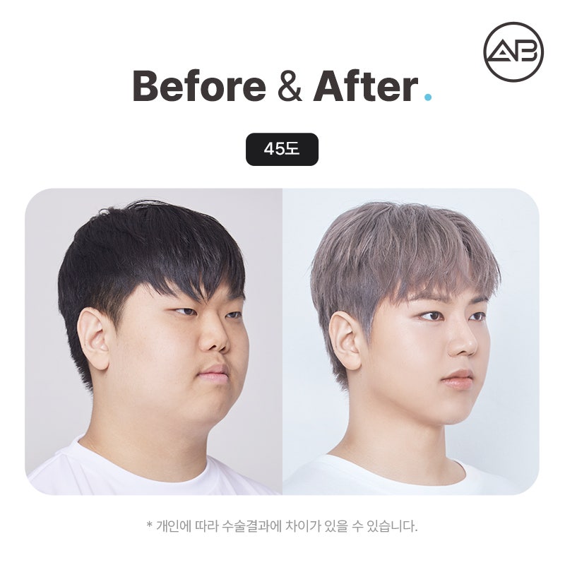 AB Plastic Surgery on MAKE미남 Episode 7 - Looking into the Short Nose Surgery for Gaseum Aen I Nae Namja! image 5