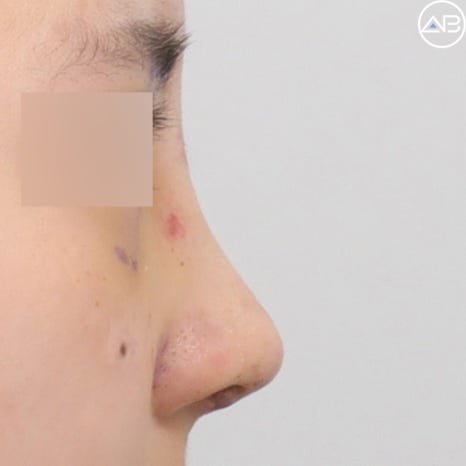 Case Review of Bulbous Nose Surgery That Transformed the Face into a Natural and Refined Look (feat. AB Plastic Surgery) image 4