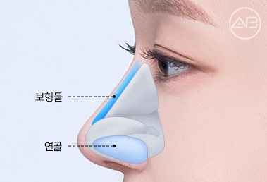 Learn About and Decide on AB Plastic Surgery’s Hump Nose Correction and Implant-Free Rhinoplasty image 4