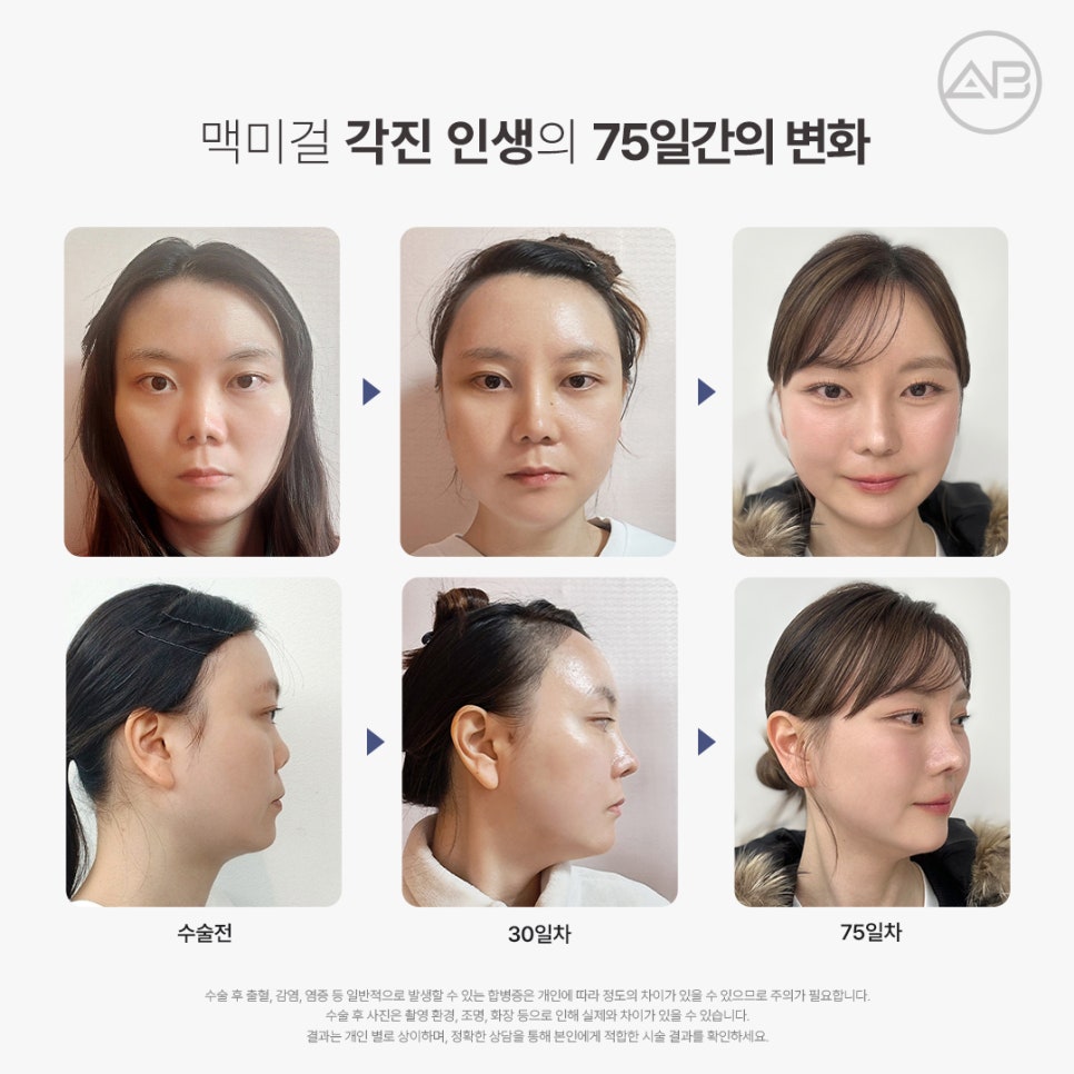 AB Plastic Surgery Contracted Nose Autologous Rib Short Nose Revision Correction Before and After image 2