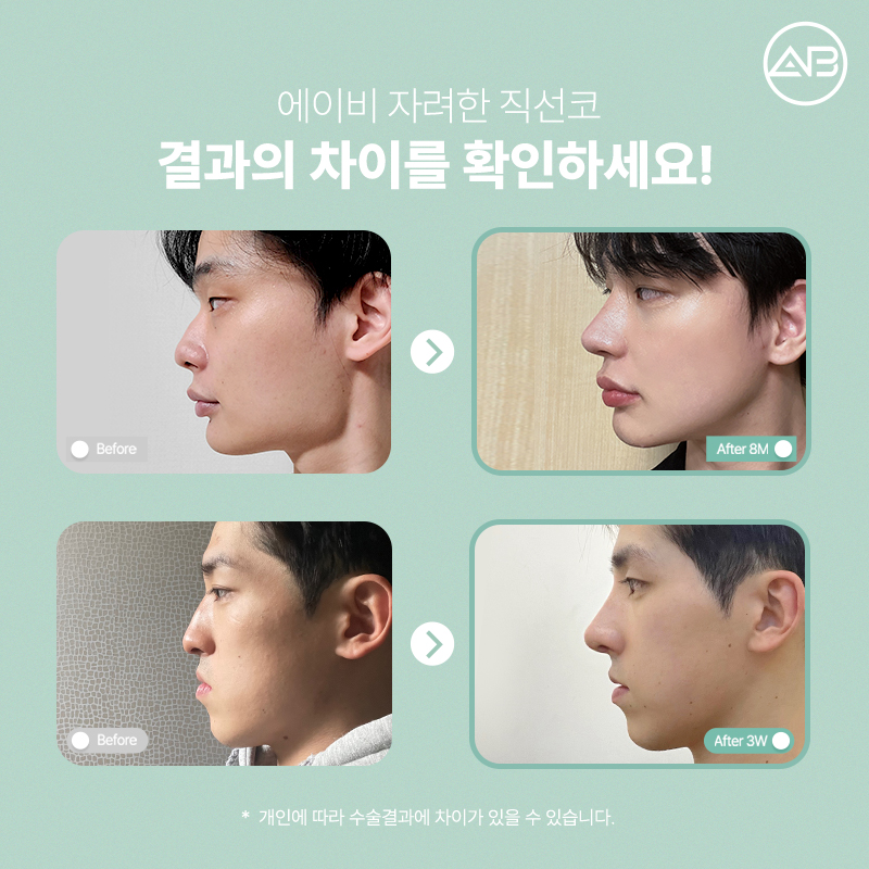 자려한직선코성형은 역시 에이비성형외과 관련 이미지 3