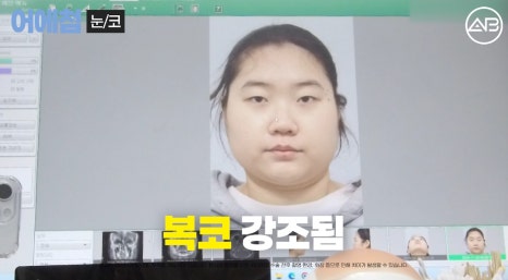에이비성형외과 맥미걸(MAKEMEGirl) 맥미돌 코성형 상담 과정 관련 이미지 2