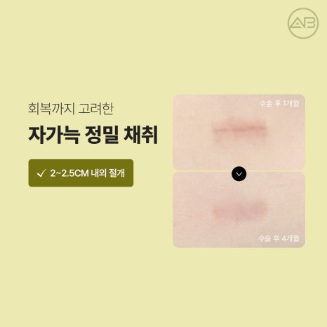 에이비성형외과 자가늑연골 비주라인 코재수술 시기와 교정 체크포인트 관련 이미지 3