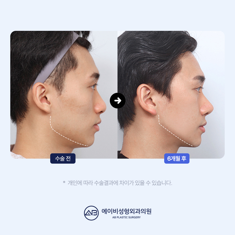 남자 윤곽수술잘하는곳 볼 때 고려해야 할 점 관련 이미지 8