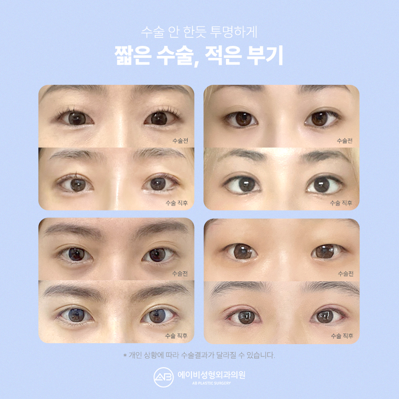 If You Want Elegant Eyes, AB’s Elegant Transparent Adhesion image 5
