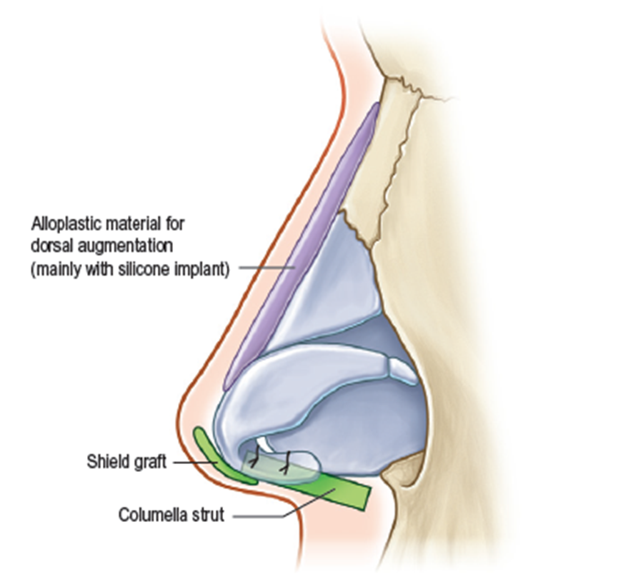 Q. Is it possible to have your first nose surgery without an implant? image 1
