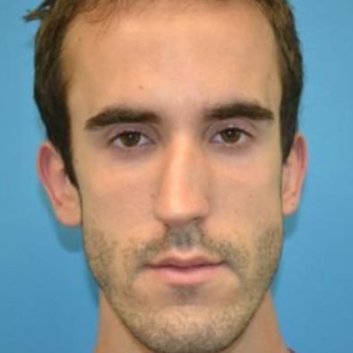 Q. I’ve had a crooked nose since I was young... is surgery possible? image 1
