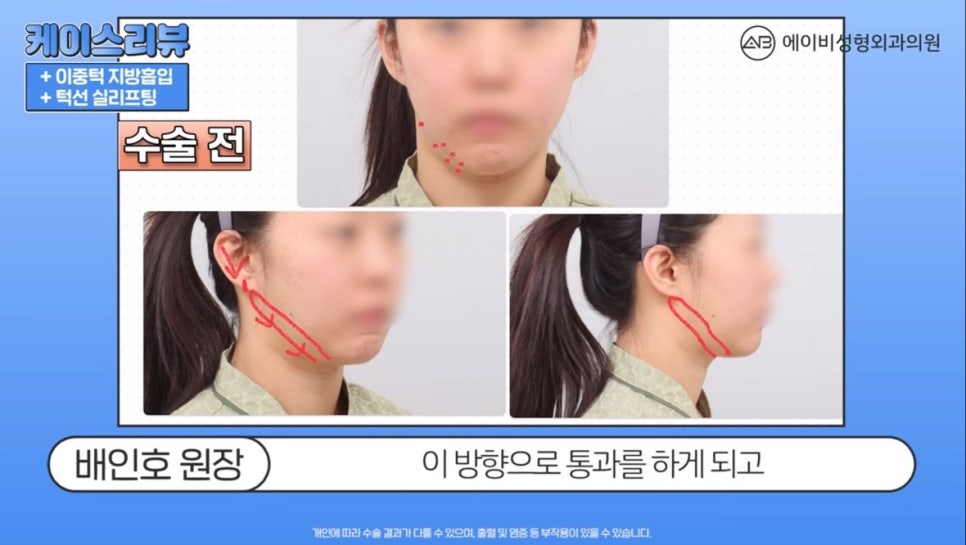 #AB Plastic Surgery #AB TV #Case Review #Double Chin Liposuction image 4