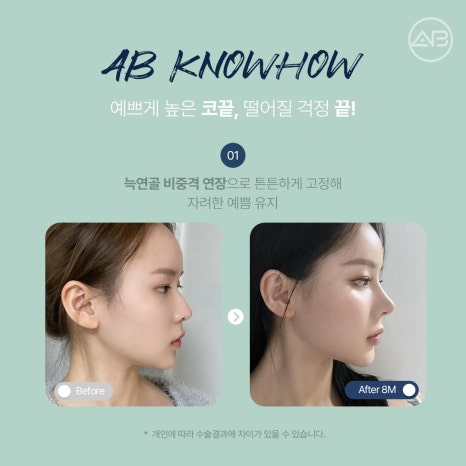 자려한코성형 원한다면 에이비성형외과 관련 이미지 6